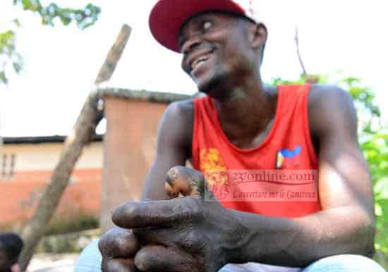 Le Cameroun marque de bons points dans la lutte contre la lèpre
