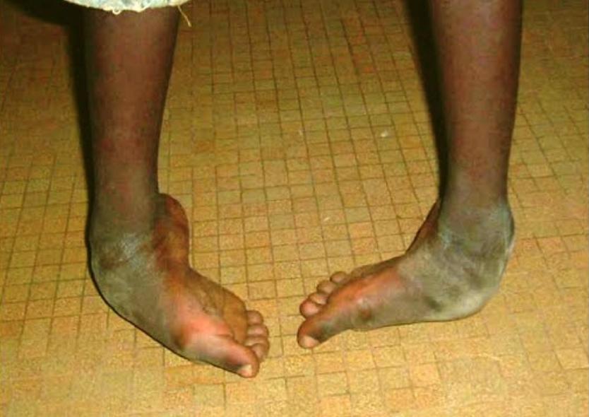 traitement du pied de bot