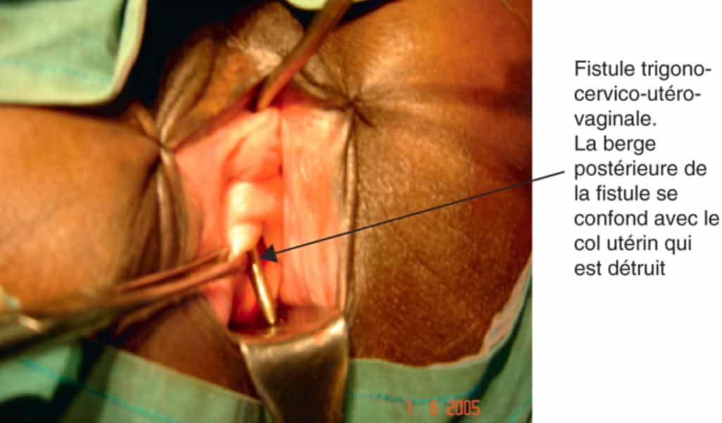 Fistule obstétricale