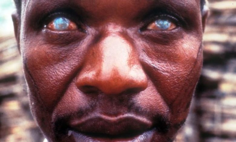 Cameroun - Santé : Vers l’élimination de l’onchocercose 1 onchocercose