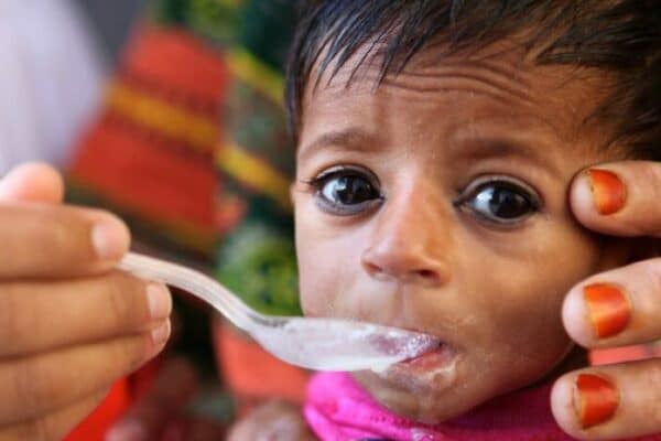 Une explosion catastrophique des taux de malnutrition sévère chez les enfants menace le monde, selon l’UNICEF