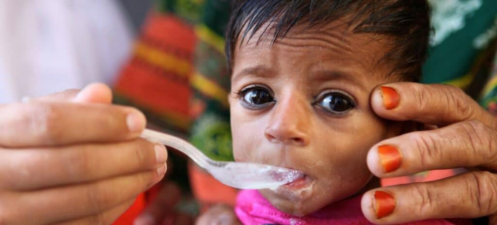 une explosion catastrophique des taux de malnutrition severe chez les enfants menace le monde selon lunicef