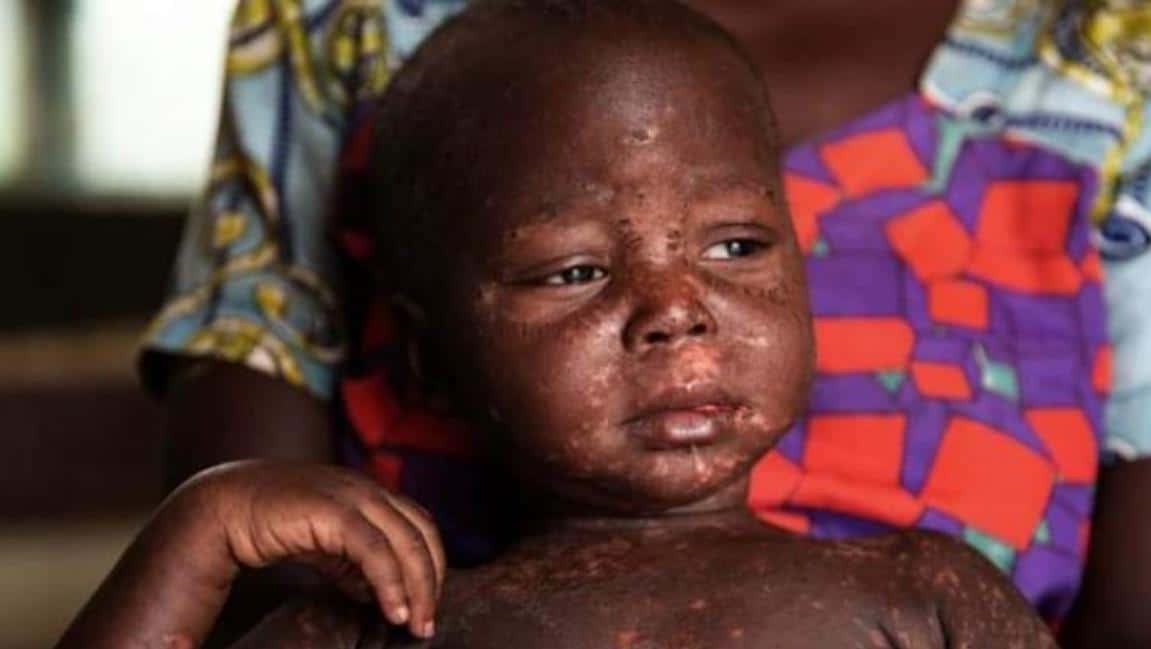 Cameroun : Campagne de vaccination imminente contre la rougeole et la rubéole