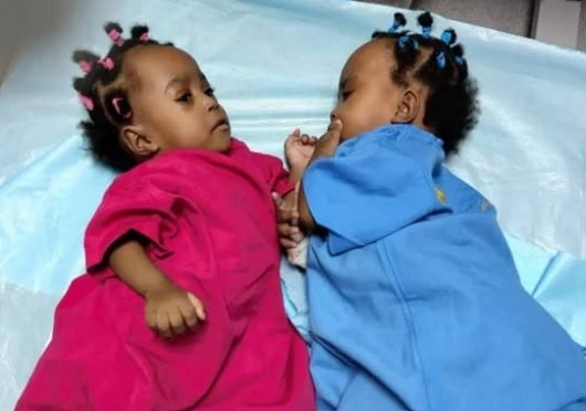 Séparation siamoises : Réussite médicale en Côte d’ivoire !